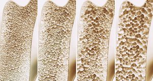 Complications of Hyperparathyroidism