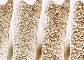 Complications of Hyperparathyroidism