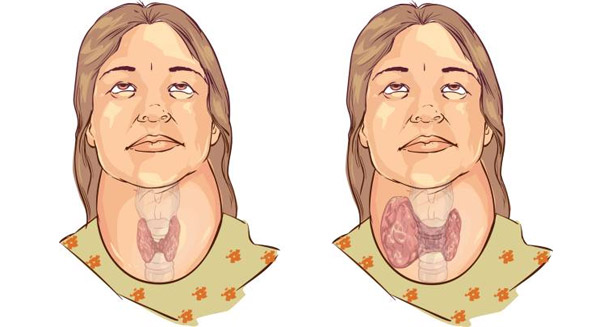 Illustration showing neck swelling due to complications of hypoparathyroidism