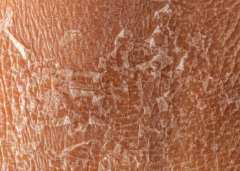 Complications of ichthyosis showing cracked and scaly dry skin on a close-up view