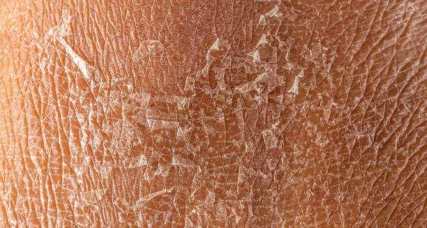 Complications of ichthyosis showing cracked and scaly dry skin on a close-up view