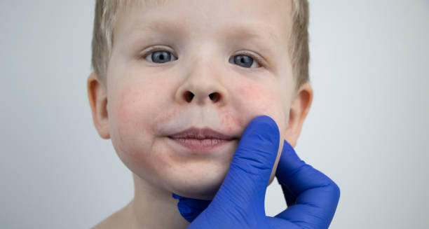 Child with facial skin irritation due to complications of impetigo