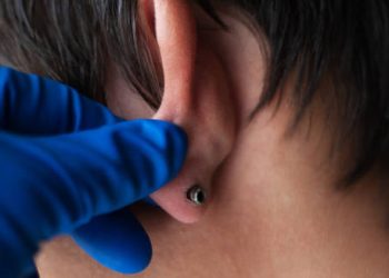 Close-up of an infected ear piercing being examined