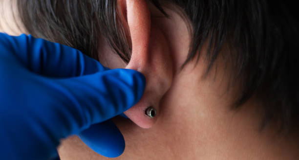 Close-up of an infected ear piercing being examined