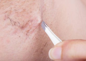 Complications of Ingrown Hairs