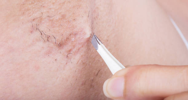 Complications of Ingrown Hairs