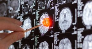 MRI brain scan showing highlighted pressure area with medical pointer