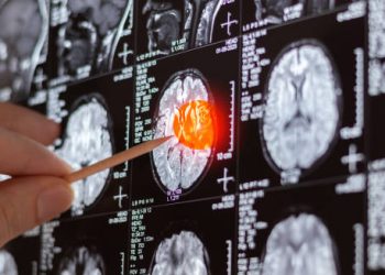 MRI brain scan showing highlighted pressure area with medical pointer