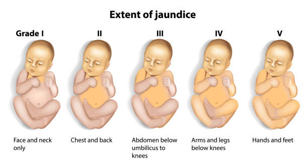 Illustration showing the extent of jaundice in newborns from Grade I to Grade V based on body coverage