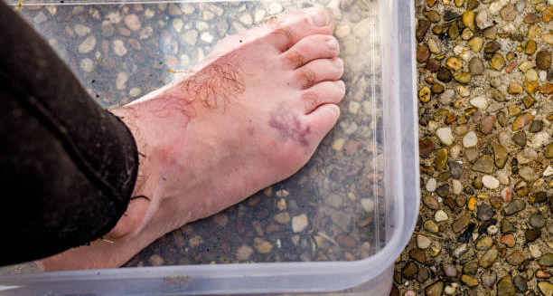 Injured foot with jellyfish sting complications submerged in water showing bruising and inflammation