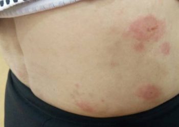 Red circular skin rashes on the abdomen indicating complications of Kawasaki Disease