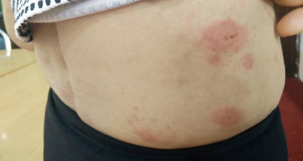 Red circular skin rashes on the abdomen indicating complications of Kawasaki Disease