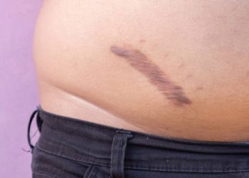 Dark raised keloid scar on lower abdomen showing post-inflammatory pigmentation