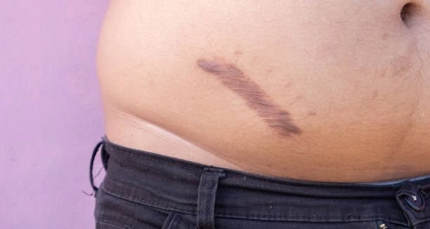 Dark raised keloid scar on lower abdomen showing post-inflammatory pigmentation