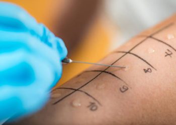 Skin prick test for food allergy diagnosis on forearm