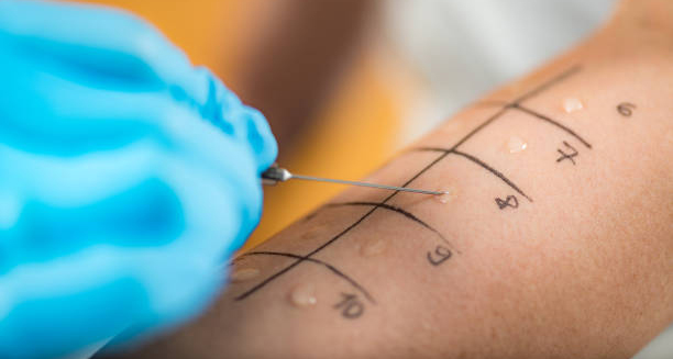 Skin prick test for food allergy diagnosis on forearm