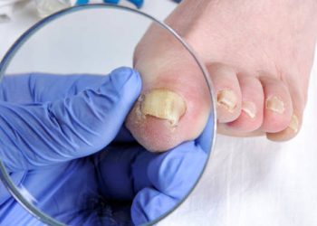 Doctor examining toenail with fungal infection using a magnifying glass