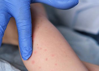 Close-up of a child's rash on the arm being examined for German measles diagnosis