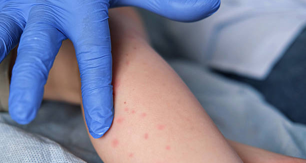 Close-up of a child's rash on the arm being examined for German measles diagnosis