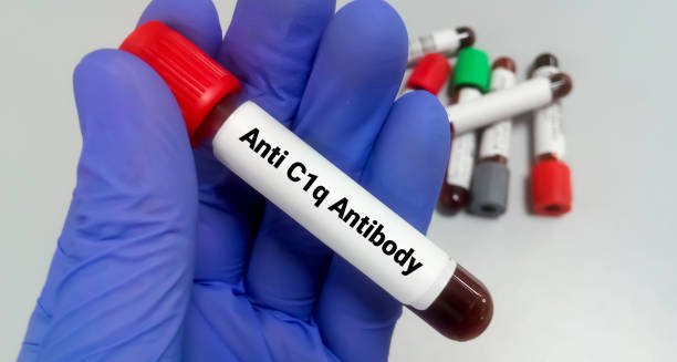 Blood test sample labelled Anti C1q Antibody held by gloved hand