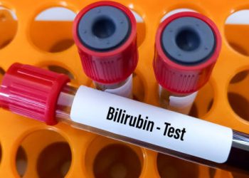 Blood sample for bilirubin test used in diagnosing Gilbert’s Syndrome