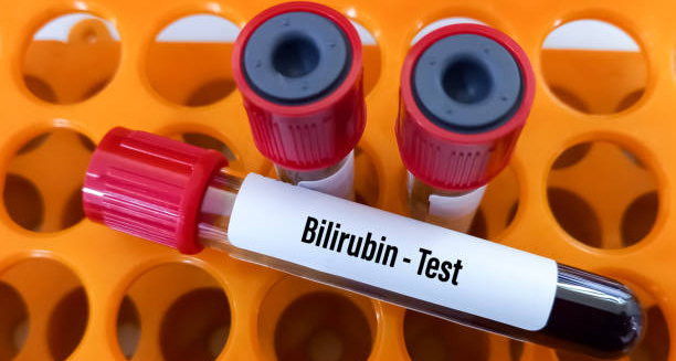 Blood sample for bilirubin test used in diagnosing Gilbert’s Syndrome
