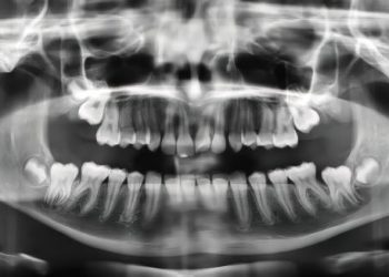 Dental X-ray showing bone loss and periodontal issues related to gum disease