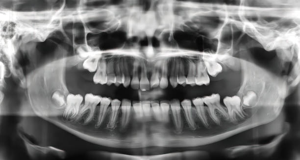 Dental X-ray showing bone loss and periodontal issues related to gum disease