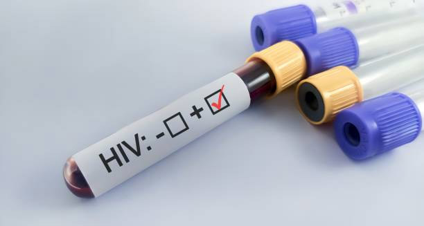 Positive HIV test result in a labelled blood sample tube