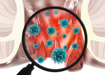 Diagnosis of Haemorrhoids