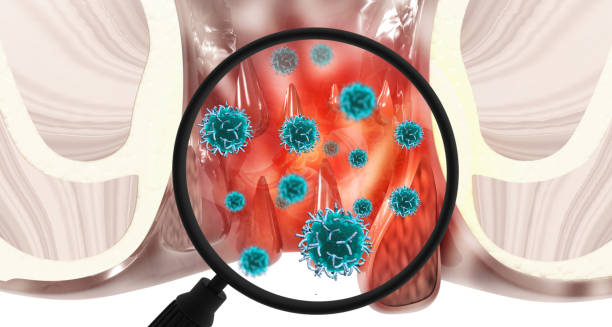 Diagnosis of Haemorrhoids