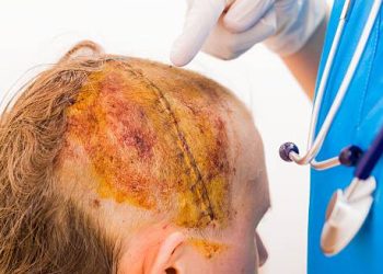 Diagnosis of Hair Dye Reactions