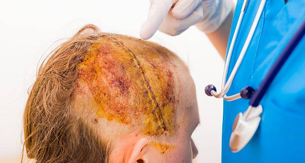 Diagnosis of Hair Dye Reactions