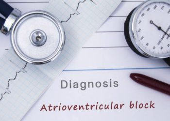 Stethoscope, ECG strip, and blood pressure cuff with the words “Diagnosis Atrioventricular block”