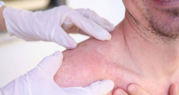 Doctor examining red irritated skin on a man's shoulder for signs of heat rash
