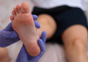 Medical examination of child’s foot showing purpuric rash typical of Henoch-Schönlein Purpura
