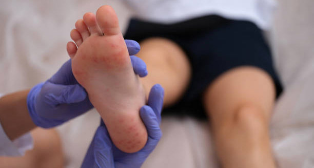Medical examination of child’s foot showing purpuric rash typical of Henoch-Schönlein Purpura
