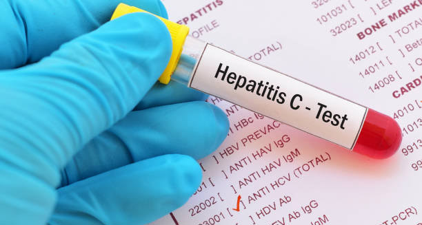Hepatitis C blood test sample held by gloved hand over lab results