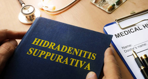 Medical book titled Hidradenitis Suppurativa next to a clipboard with patient health records and a stethoscope