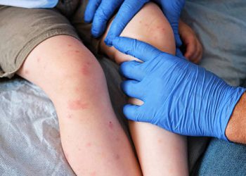 Doctor examining red welts and hives on a child’s legs