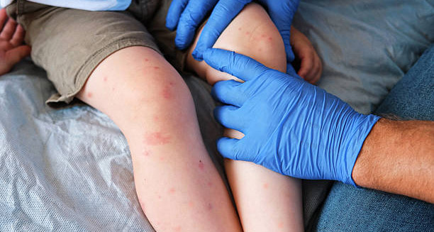 Doctor examining red welts and hives on a child’s legs