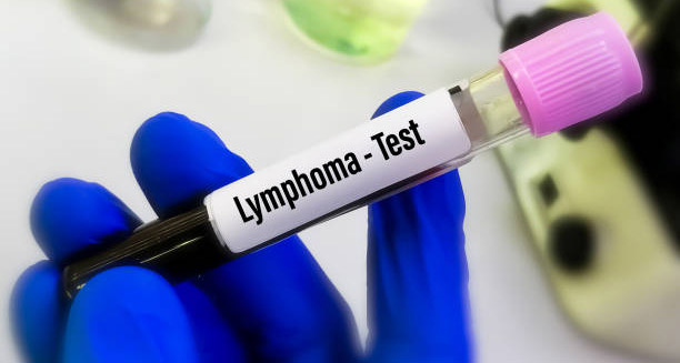 Blood sample labelled for lymphoma testing, used in the diagnosis of Hodgkin lymphoma