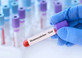 Diagnosis of Homocystinuria