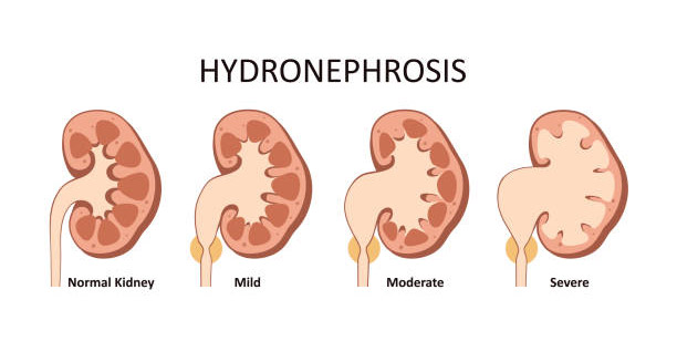 Visual comparison of kidney stages in hydronephrosis diagnosis