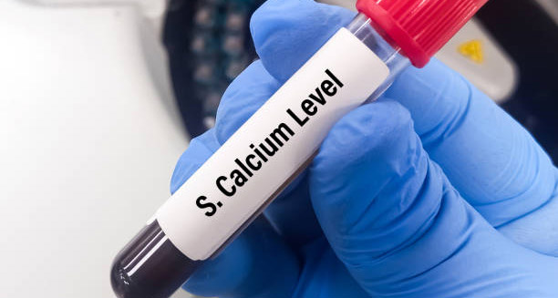 Blood sample tube labelled S. Calcium Level held by gloved hand for hyperparathyroidism diagnosis
