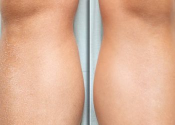 Comparison of dry scaly leg skin and smooth skin to diagnose ichthyosis