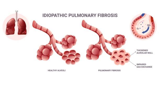 Medical illustration comparing healthy alveoli and fibrotic lungs in idiopathic pulmonary fibrosis