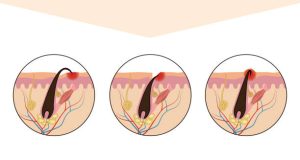 Diagnosis of Ingrown Hairs