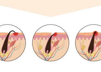Diagnosis of Ingrown Hairs