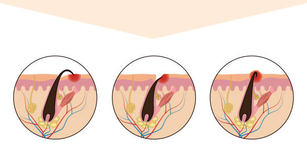 Diagnosis of Ingrown Hairs